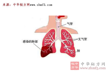 治肺炎驗方二則