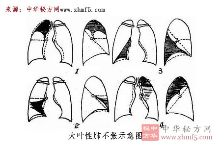 大葉性肺不張示意圖