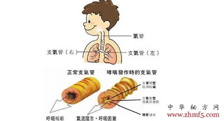 治支氣管哮喘驗(yàn)方20則