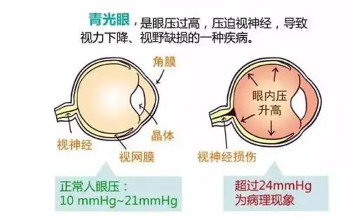 青光眼到瞎一般得多久 青光眼失明是遲早的嗎