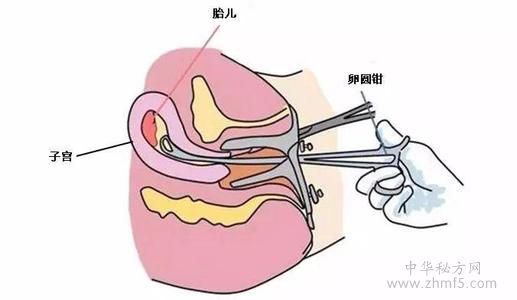 子宮粘連最佳治療方法