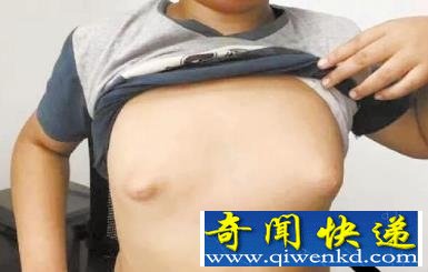 姐姐1個(gè)胸6斤重 姐弟乳房發(fā)育過大的元兇揭露