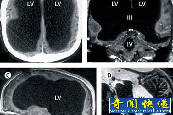 大腦神秘消失？美國男子大腦竟消失75%