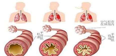 支氣管哮喘如何根治，試試這幾個(gè)哮喘偏方