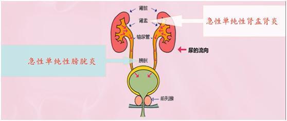 為什么有些人性生活后有尿感？有些人性生活后尿感的主要原因