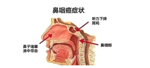 鼻咽癌的癥狀,鼻咽癌的癥狀和起因