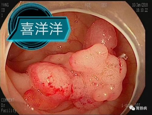 息肉結腸切除的副作用_息肉結腸切除的副作用是什么