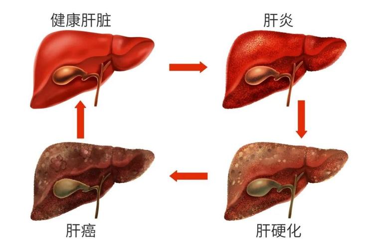 丙肝炎的早期癥狀_丙肝炎的早期癥狀表現(xiàn)有哪些