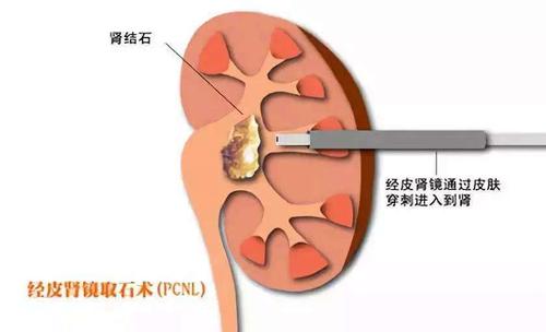 腎結(jié)石碎石有沒(méi)有副作用-腎結(jié)石碎石有沒(méi)有副作用和危害