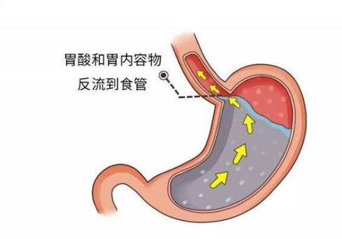 胃食管反流病癥狀-胃食管反流病癥狀分度