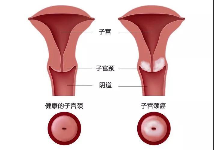 重度宮頸糜爛的癥狀_重度宮頸糜爛的癥狀有哪些圖片