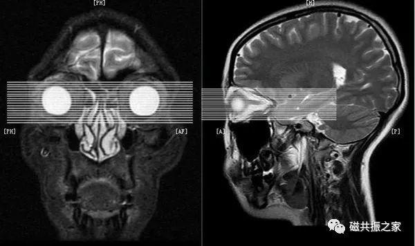 眼磁共振有什么副作用_眼磁共振有什么副作用和危害