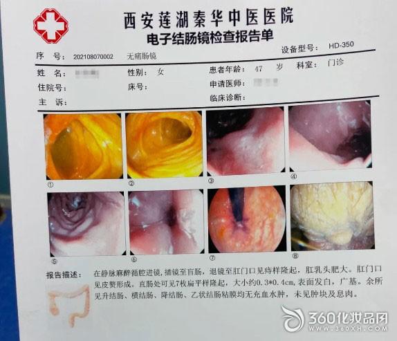 息肉結腸切除的副作用_息肉結腸切除的副作用是什么