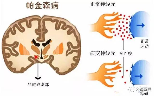 帕金森氏癥早期癥狀-帕金森氏癥早期癥狀是什么