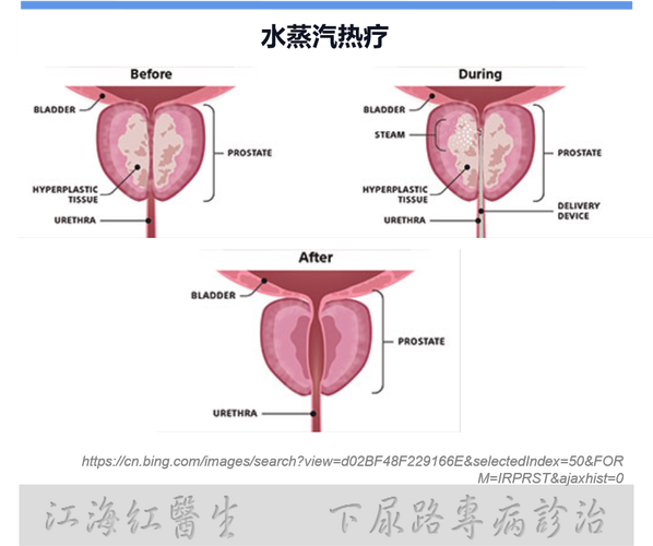 前列腺蒸汽消融術(shù)的副作用