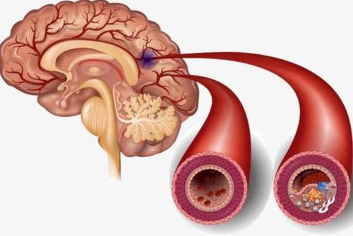腦供血不足癥狀表現(xiàn)有哪些腦供血不足癥狀表現(xiàn)有哪些怎么治療
