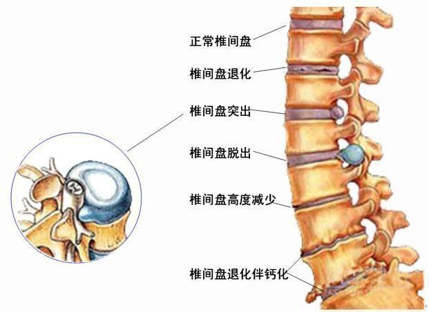 腰間盤突出早期癥狀(腰間盤突出早期癥狀怎么治療)