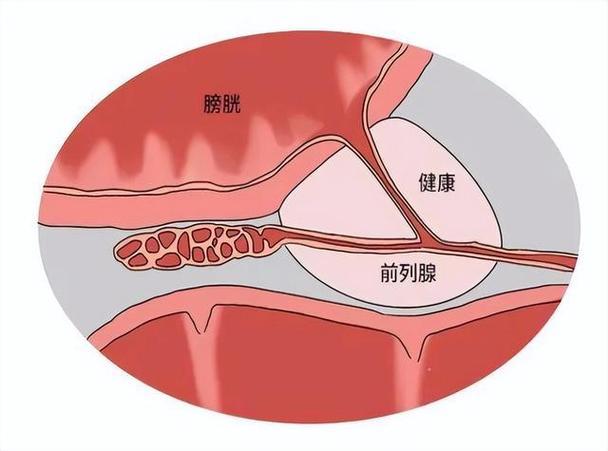 前列腺疾病的癥狀_如何判斷自己前列腺炎