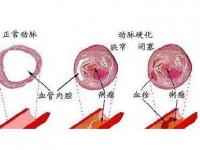 腦動(dòng)脈硬化癥狀_腦動(dòng)脈硬化癥狀的5個(gè)癥狀