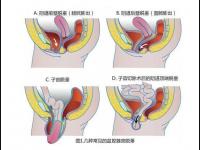 子宮下垂的癥狀(子宮下垂的癥狀動(dòng)畫(huà))