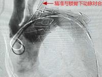 鎖骨下動脈支架副作用,鎖骨下動脈支架副作用是什么