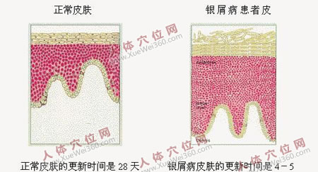 奇方治銀屑病130余例，有效率100%