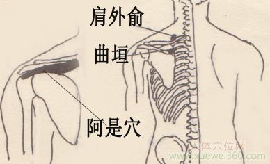 拔罐治療岡上肌損傷