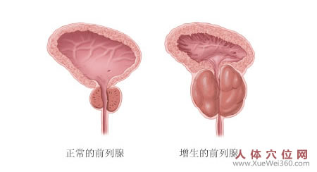 按摩治好了前列腺增生